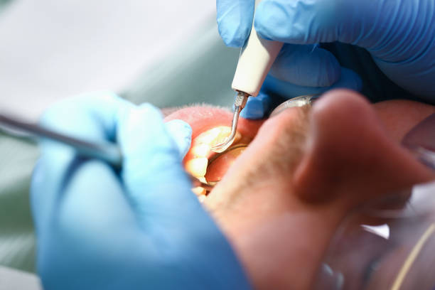 Best Emergency Wisdom Teeth Removal in Tekamah, NE